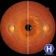 Diyabetik retinopati nedir, belirtileri nelerdir ve nasıl tedavi edilir?