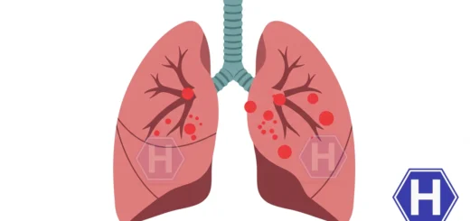 Akciğer metastazları, vücudun başka bir bölgesinde ortaya çıkan primer kanser hücrelerinin dolaşım yoluyla ya da lenf sistemi aracılığıyla akciğerlere yayılmasıyla gelişen ikincil tümörlerdir. Akciğerler, vücudun en yoğun damar ağlarından birine sahip olduğu için kan yoluyla taşınan kanser hücreleri burada kolaylıkla tutunabilir.